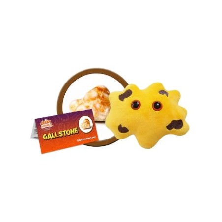 GIANTMICROBES CALCOLO BILIARE Gallstones