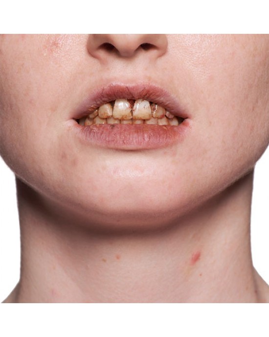 SMALTO PER DENTI KRYOLAN